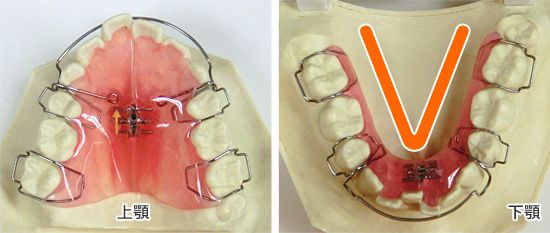 子供 歯 列 矯正 費用