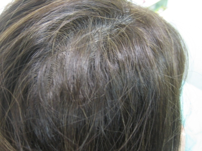 縮毛矯正 ジリジリ