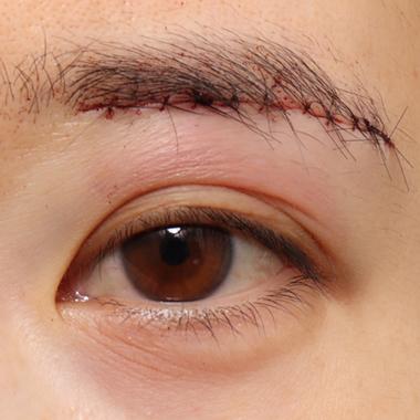 まぶた 内出血 原因