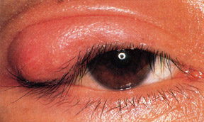 はやり 目 初期 症状