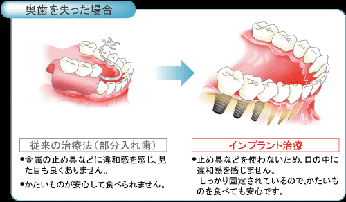霧島市 インプラント