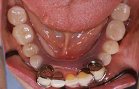 奥歯 部分 入れ歯