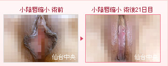 しょういんしん 縮小