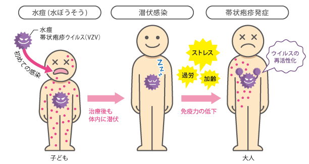 帯状疱疹はうつる？