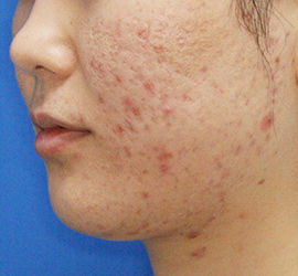 肌 クレーター 治す