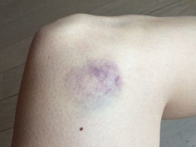 身に覚えのないあざ 白血病