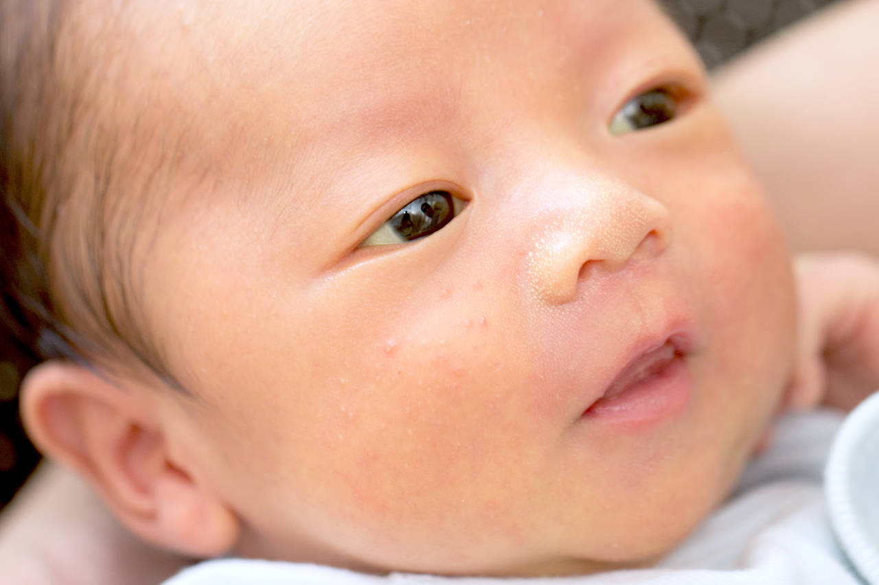 赤ちゃん ほっぺ できもの