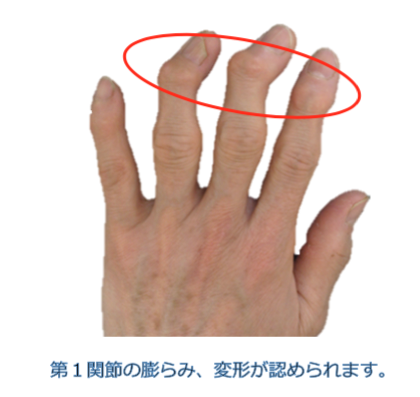 ヘバーデン 結節 名医